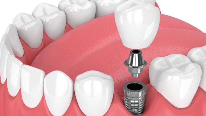 Diş İmplantları Hakkında 5 Efsane