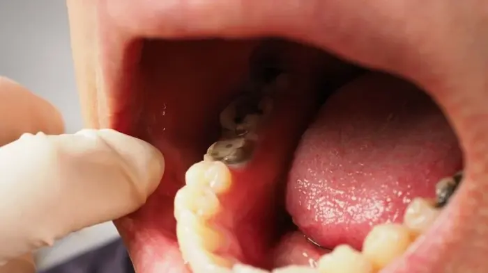 Dünyanın üçte birinden fazlası diş çürüğüyle yaşıyor!