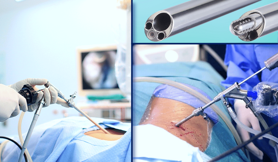 Kapalı Bel Fıtığı Ameliyatı, Hastalara Avantaj Sağlıyor