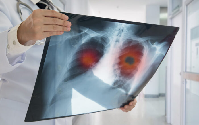 MRI Rehberli Kriyoablasyonla Kesiksiz Kanser Tedavisi!